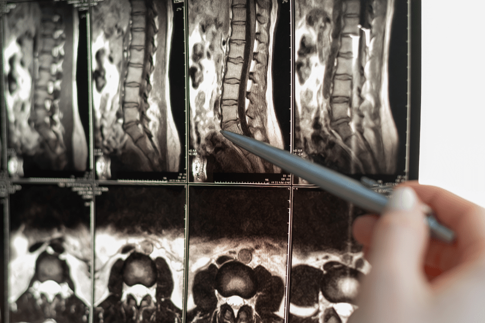 Spinal Cord Injury Lawyers - Walnut Creek